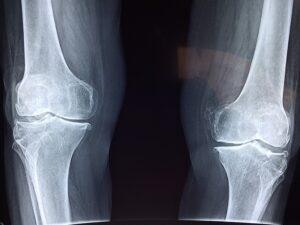 What are Symptoms of a Bone Fracture after an Accident?