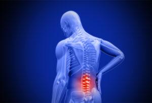 Can I Get Long-Term Disability for Chronic Back Pain?
