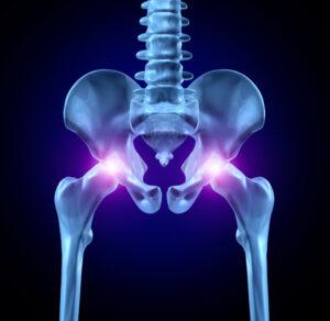 Do I Need an Injury Attorney for a Broken Hip or Pelvis Fracture in Kansas & Missouri?
