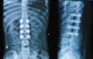 How Cervical and Lumbar Spine Fusions Result from Car Accidents in Missouri & Kansas